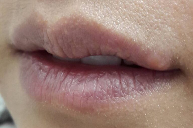 Não é possível se livrar do vírus da herpes labial, mas há formas de diminuir os sintomas