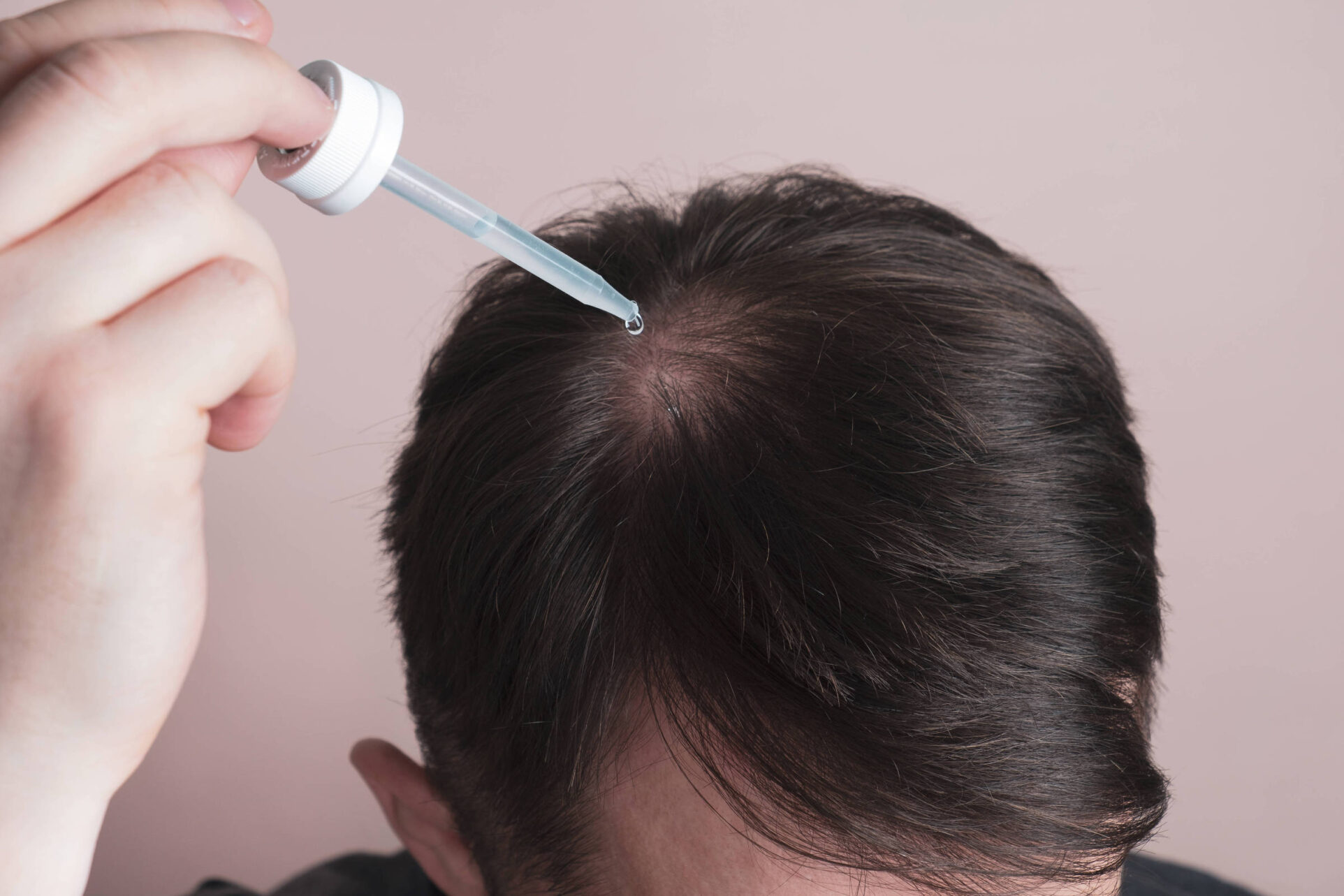 Minoxidil pode causar crescimento anormal de pelos em bebês, alerta Anvisa