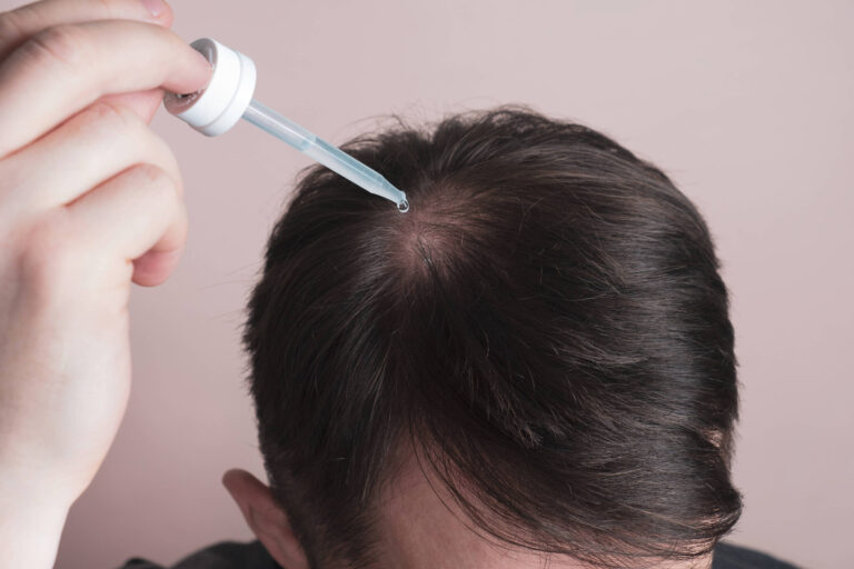 Minoxidil pode causar crescimento anormal de pelos em bebês, alerta Anvisa