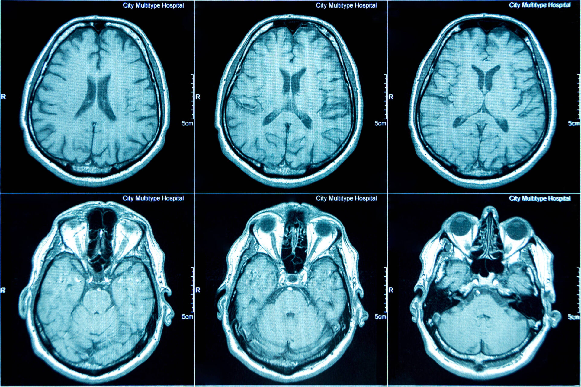 União Europeia aprova tratamento pioneiro contra o Alzheimer